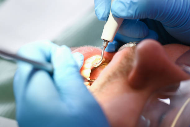 Best Emergency Root Canal Treatment in Bolingbrook, IL