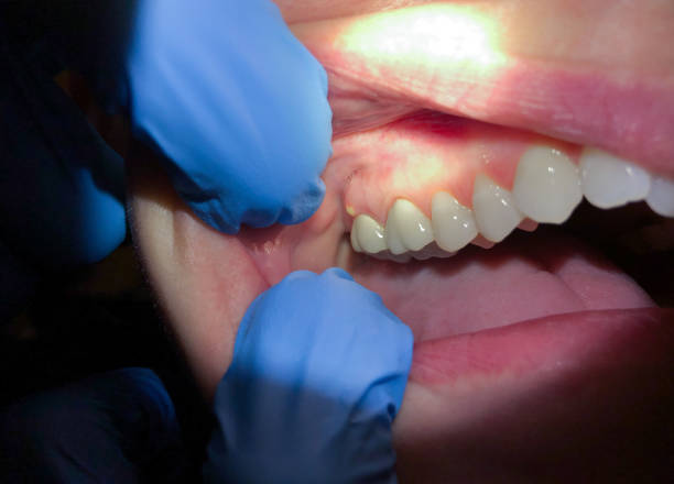 Best Emergency Treatment for Dental Infections or Abscesses in Bolingbrook, IL